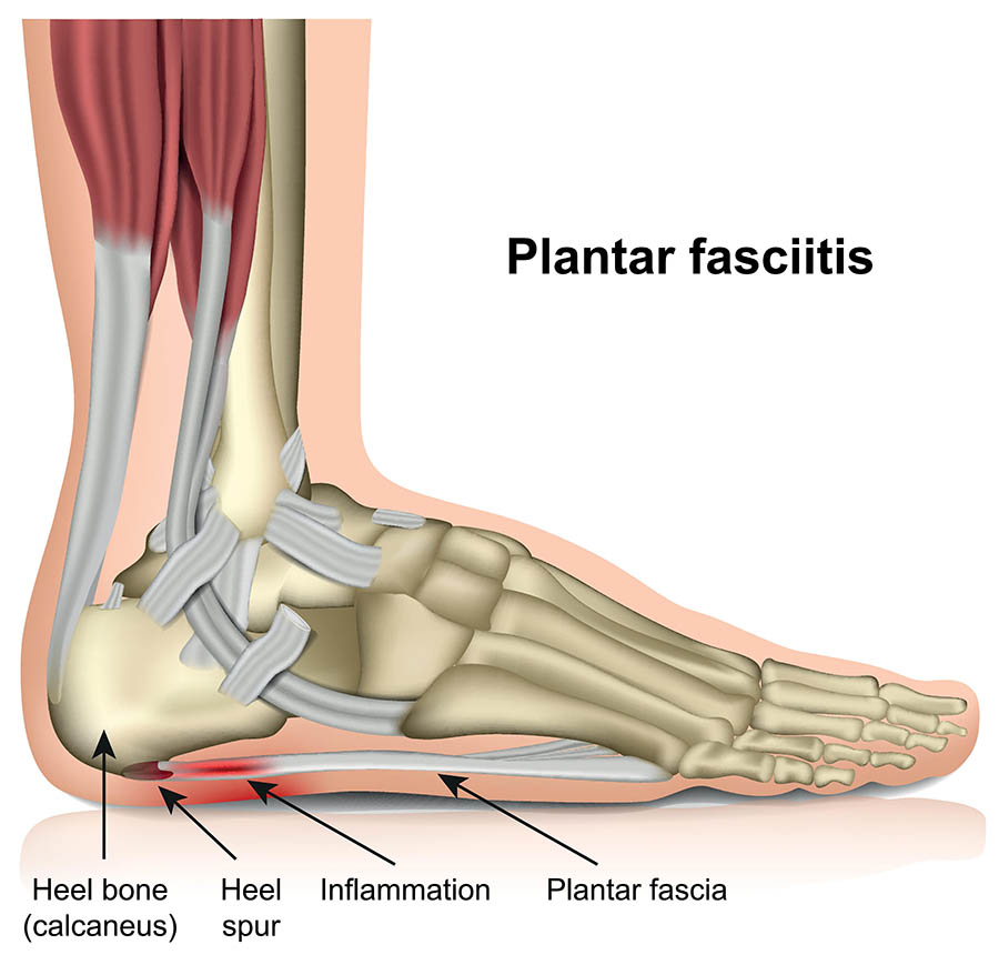 Plantar Fasciitis Anatomy